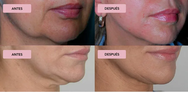 Antes Despues Morpheus8