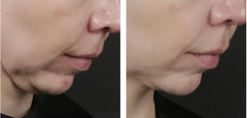 Antes Despues Morpheus8