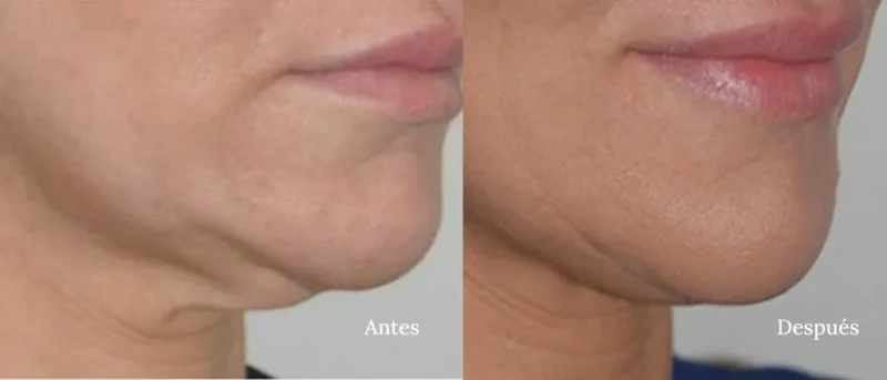 Antes y Despues Morpheus8