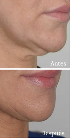 Antes y Despues Morpheus8