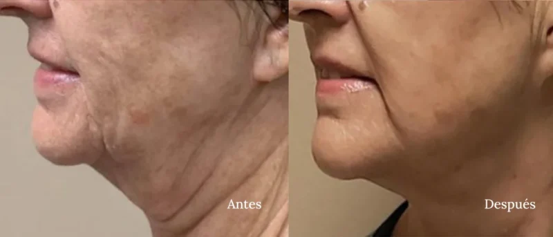 Antes y Despues Morpheus8