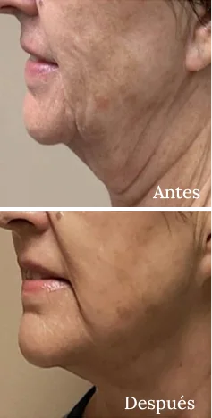 Antes y Despues Morpheus8