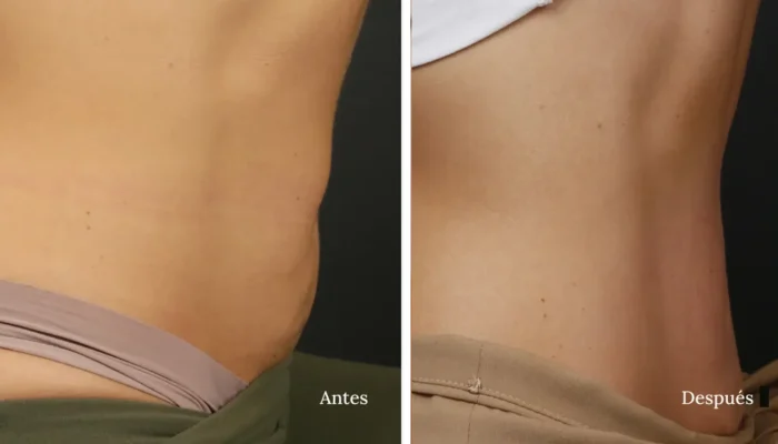 Antes y Despues Morpheus8