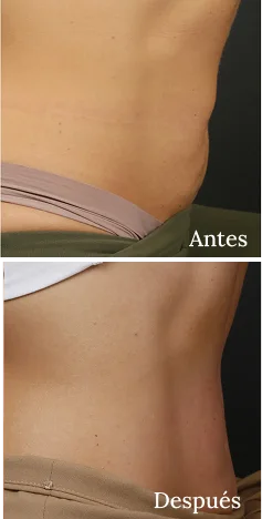 Antes y Despues Morpheus8