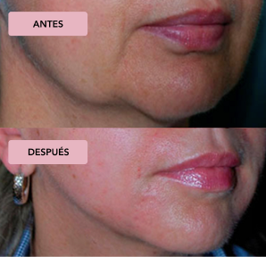 Antes y Despues Morpheus8