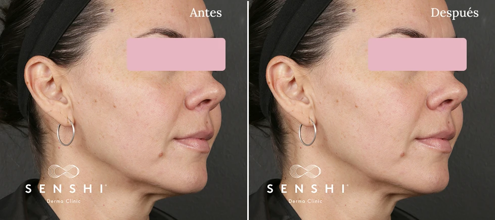 Piel radiante y sin imperfecciones en rostro femenino Ultherapy Lifting