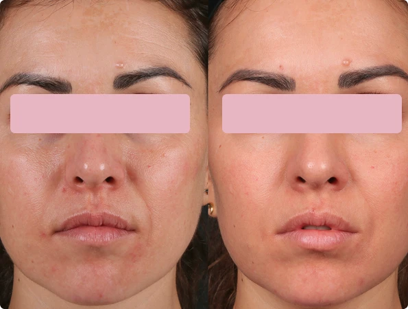 Resultados antes y después de Ultherapy Liftingen cuello y escote sin cirugía