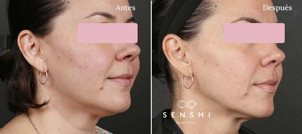 Piel radiante y sin imperfecciones en rostro femenino Ultherapy Lifting