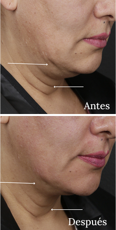 Antes y Después Ultherapy Lifting Fotografía Rostro