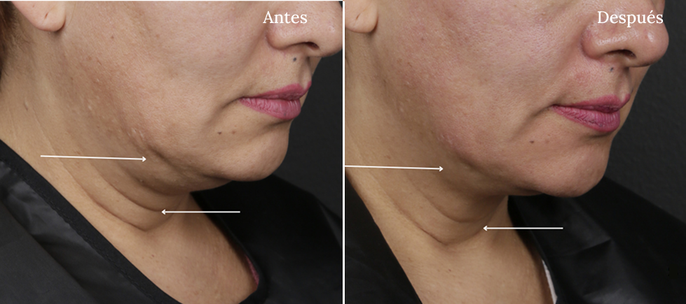 Antes y Después Ultherapy Lifting Fotografía Rostro Papada
