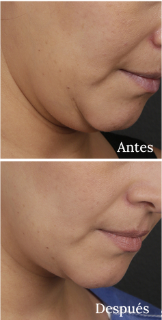 Antes y Después Ultherapy Lifting Fotografía