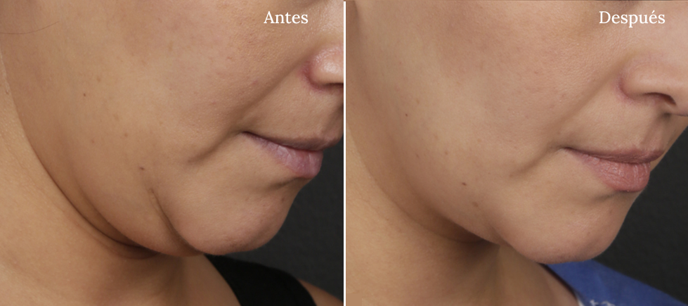 Antes y Después Ultherapy Lifting Fotografía Papada