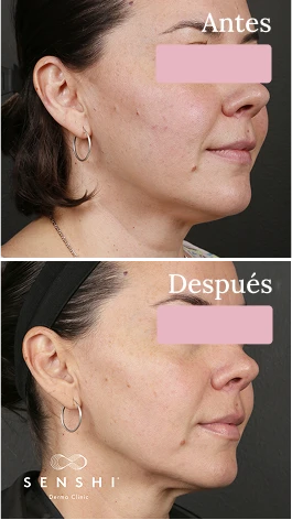Resultados antes y después de Ultherapy Lifting en cuello y escote sin cirugía