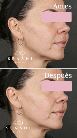 Resultados antes y después de Ultherapy Lifting en cuello y escote sin cirugía